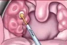 小孩经常扁桃体发炎发烧能切除吗,孩子喉咙老发炎引起发烧