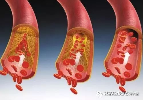 「杏林微科普」暴雨天，外出蹚水淋雨，小心得了脉管炎！