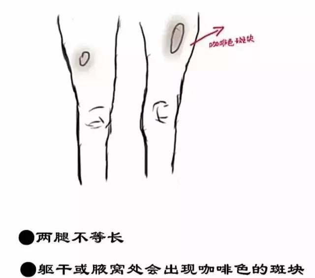 23岁姑娘撩起上衣,妈妈一看急疯了!暑假孩子一窝蜂看这病,再晚要吃大苦头!