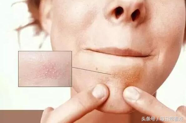 嘴抿起来有小疙瘩,如何去除嘴下的小疙瘩