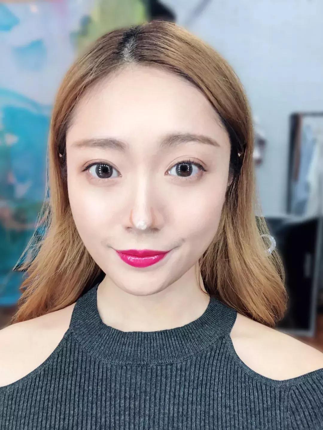 蒜头鼻怎么改变鼻型,蒜头鼻厚鼻翼怎么矫正