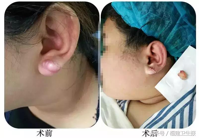 打耳洞导致长了小肉球,打耳洞耳朵长了个肉瘤