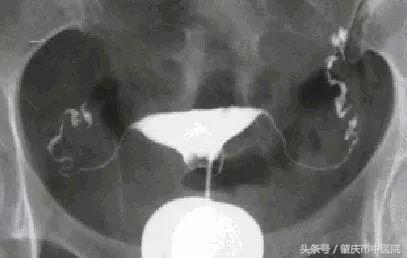 输卵管堵塞是什么原因引起的,科普妇科小知识