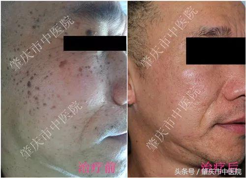 肇庆中医院激光治疗,激光切割生命之花