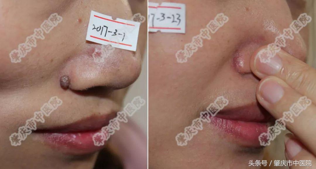 肇庆中医院激光治疗,激光切割生命之花