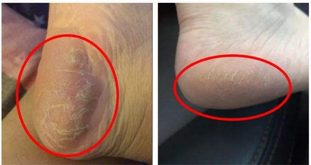 脚后跟死皮凉鞋,脚后跟死皮怎么穿凉鞋