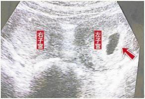 孕妇深夜分娩突然要生了,深夜产房高龄孕妈