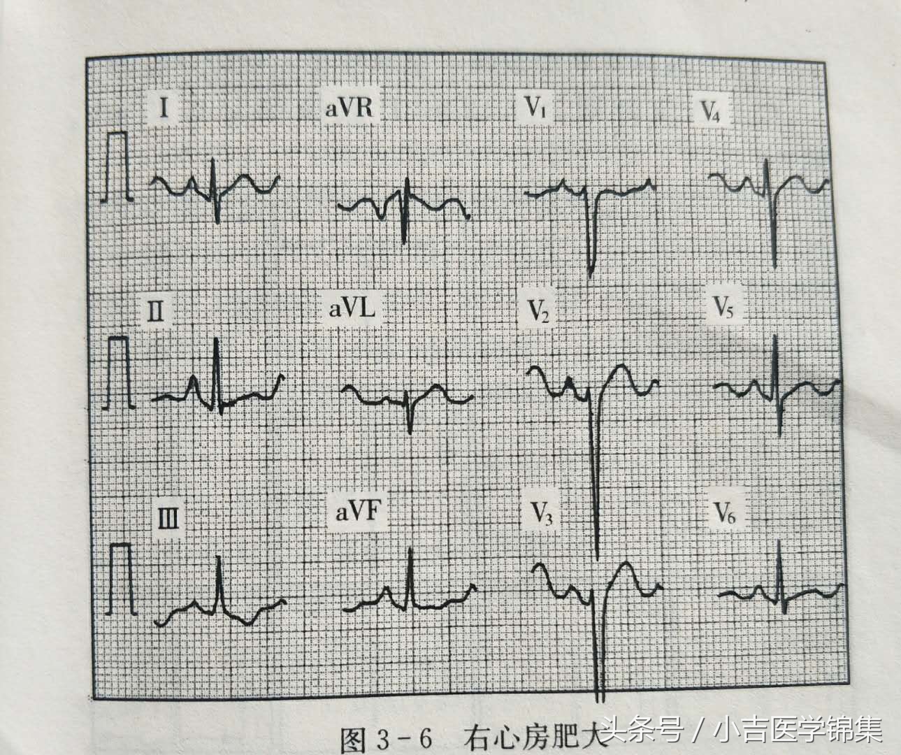 心房心室肥大,房室肥大要紧吗