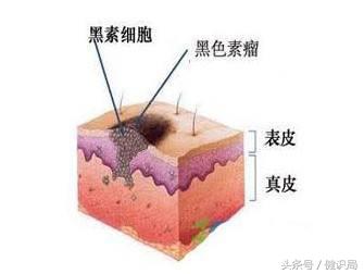 黑色素瘤新药上市,黑色素瘤新药