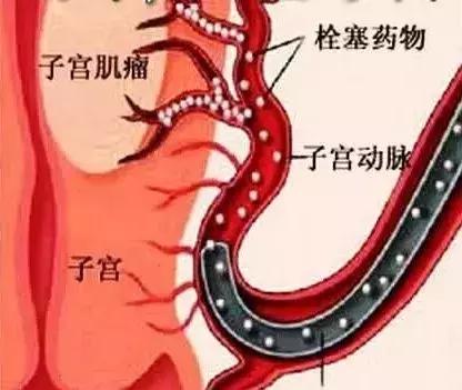 20岁子宫腺肌症能根治吗,子宫腺肌症能彻底根治吗