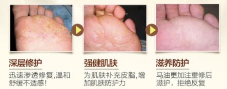 告别“香港脚”，需要用马油！一天涂抹一次，保证24小时清爽！