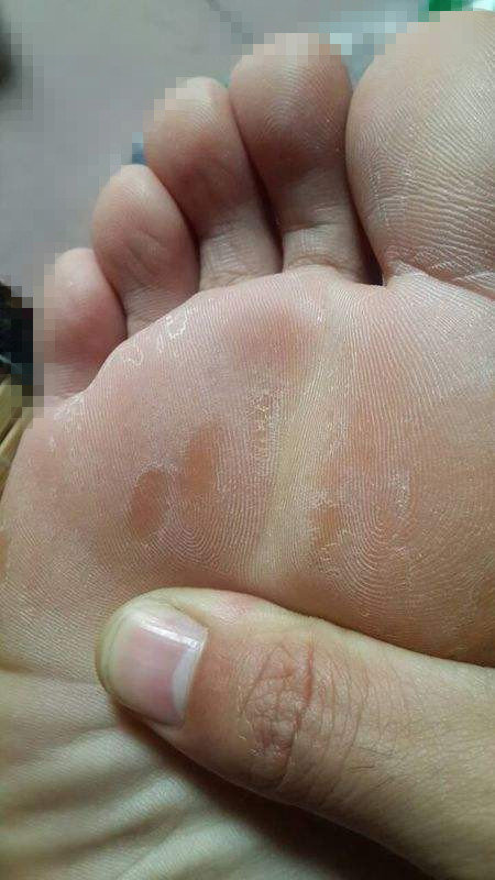 脚痒长水泡脱皮干裂要用什么方法,脚板痒脱皮长水泡是什么原因引起