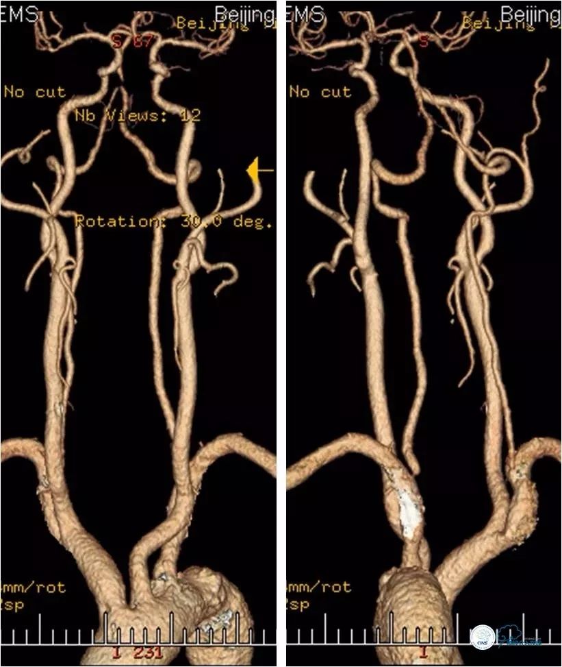 天坛周记｜左椎动脉开口及基底动脉串联狭窄血管内介入治疗1例