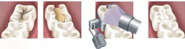 龋病科普——小洞不补，大洞吃苦！