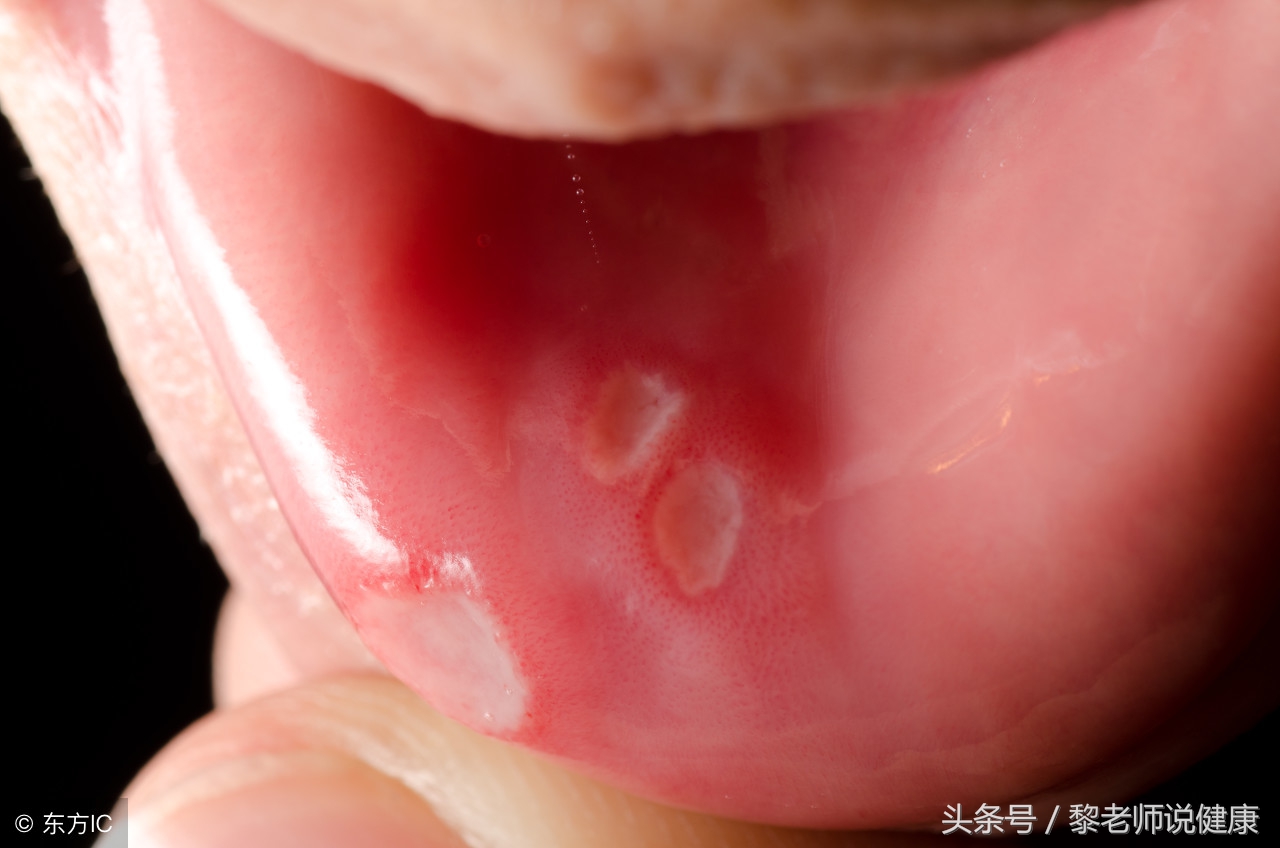 口腔溃疡都有哪些治疗的方法呢,口腔溃疡是怎么治好的
