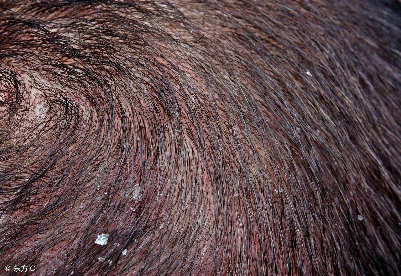 头皮屑特别多怎样防治,头皮屑增多可以试试这6个方法