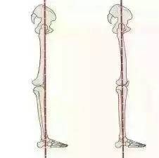 膝超伸导致的小腿粗如何解决,小腿超粗是什么原因