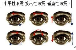 位置性眩晕眼震,眼震检查临床意义