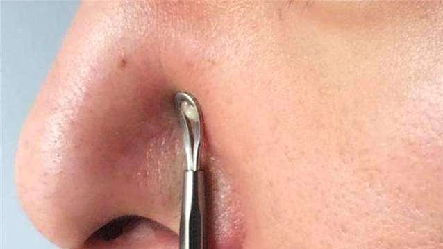 鼻子每天都能挤出白色油脂怎么治,鼻子脸部挤出白色线状米粒是什么