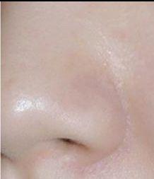 治疗毛孔粗大,激光治疗毛孔粗大多少钱