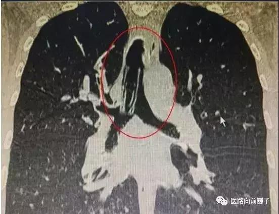 癫痫发作后是让他睡觉还是叫醒他,癫痫抽一点点烟可以吗