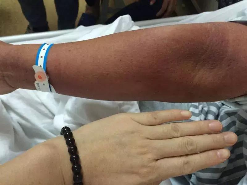 化疗后烂手烂脚怎么办,化疗手脚皮肤溃烂如何处理