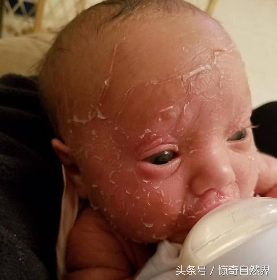 婴儿鱼鳞病出生就有吗,婴儿鱼鳞病多久会死