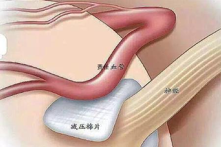 肉毒素治疗面肌痉挛操作视频,肉毒素治疗面肌痉挛的疗效如何