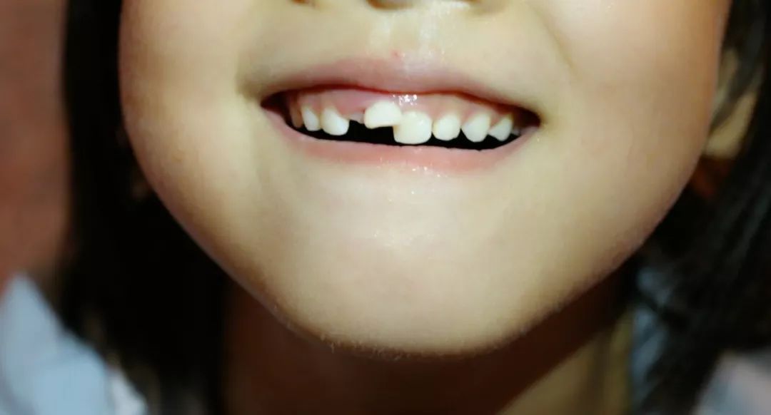 儿童换新牙长歪了怎么办,一不小心把牙给弄断了怎么办