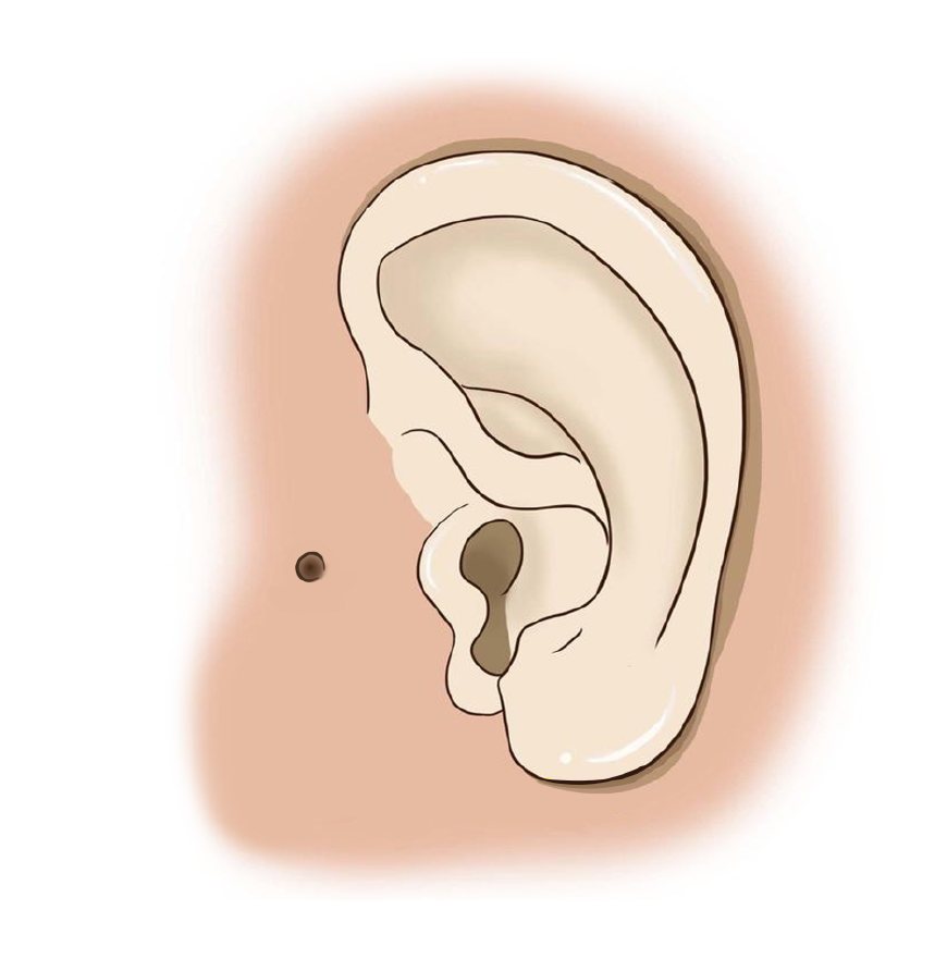 宝宝耳朵长了个东西图片,耳朵长小肉球有福气吗