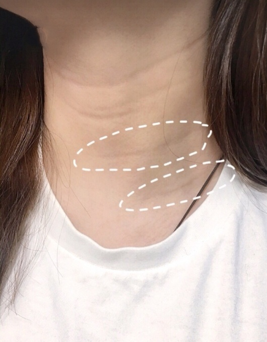 老年人的颈纹,十几岁颈纹可以慢慢恢复吗