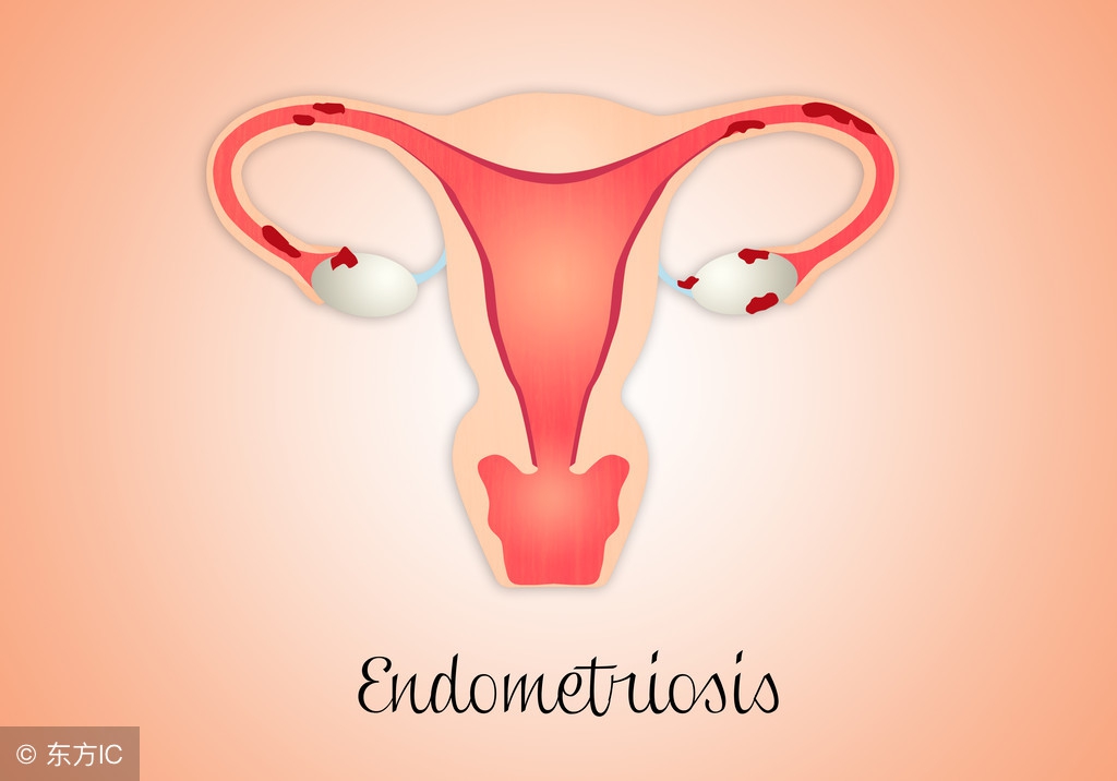 中医治疗子宫内膜增生,子宫内膜增生是癌症吗