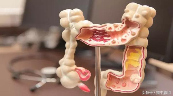 预防肠息肉：日常饮食你吃对了吗？