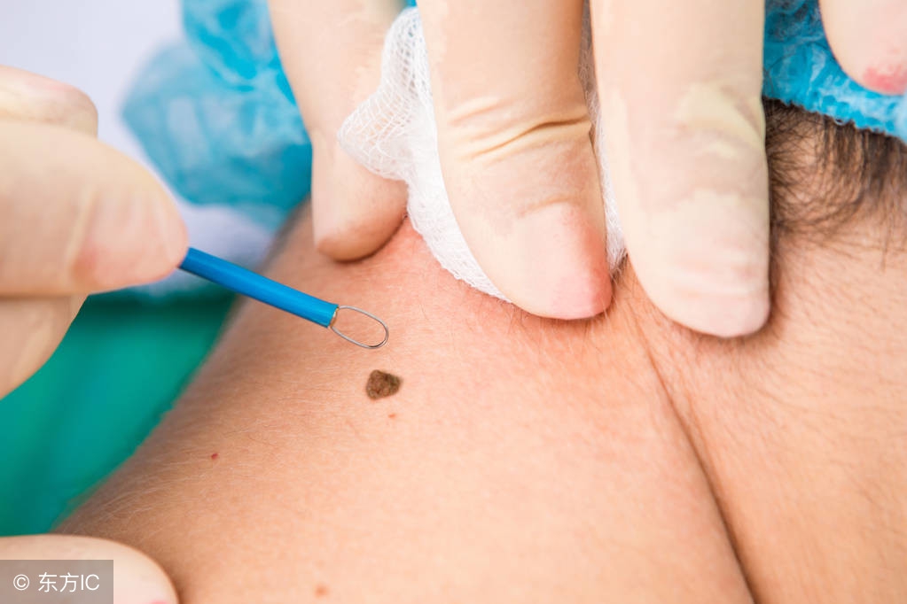 身体带红痣或黑痣的传说,身上黑痣红痣越来越多的原因