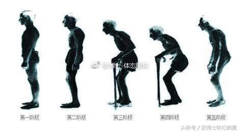 强直性脊柱炎髋关节粘连康复训练,运动疗法强直性脊柱炎研究现状