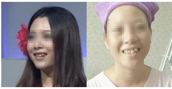 牙齿矫正8月最新价格,2024年30岁牙齿矫正费用多少钱