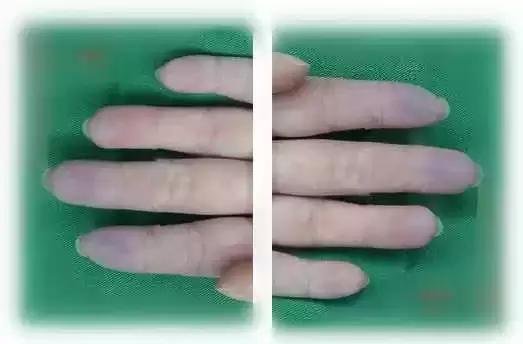 健康手掌颜色,手掌健康颜色