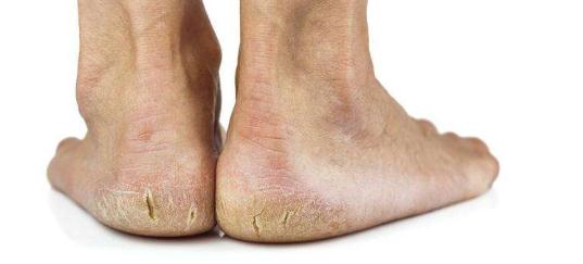 得了严重脚气好丢人怎么办,得了脚气有多尴尬