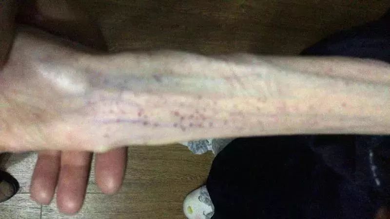 21岁女孩疯狂减肥剩50斤,女孩减肥只剩50斤照片实在太吓人