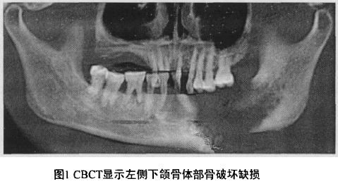 放疗能根治头颈部肿瘤吗,头颈部放疗前口腔处理