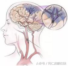 发生房颤时是侧卧还是平卧,房颤发生时及时到医院会有危险吗