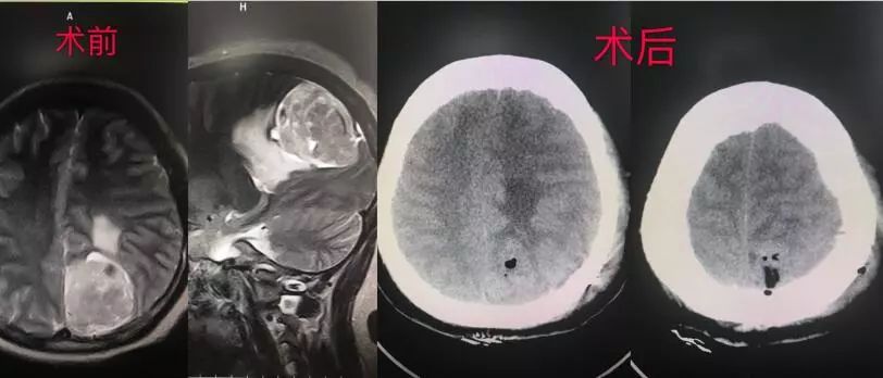 「技术硬实力」不断创新发展的玉田县中医医院脑病四科！