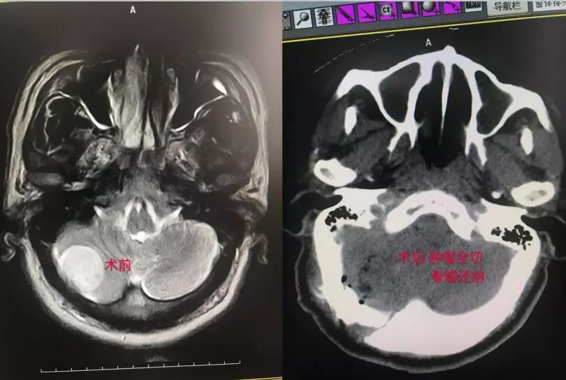 「技术硬实力」不断创新发展的玉田县中医医院脑病四科！