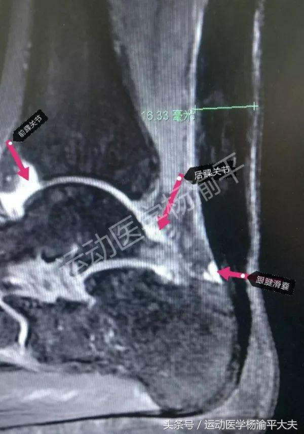 治疗滑膜炎关节积液有奇效,手指关节积液消除最佳方法
