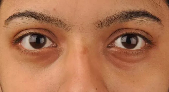 黑眼圈一直去不掉有其它原因吗,十几年黑眼圈去不掉是怎么回事