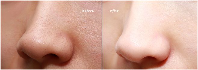 毛孔粗大医美怎么解决,油皮泛红毛孔粗大医美