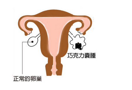 痛经会导致卵巢肿块吗,卵巢有气泡痛经怎么办