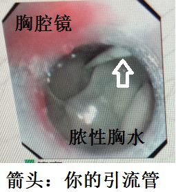 胸水为什么会抽不到,胸水抽了为什么还呼吸困难
