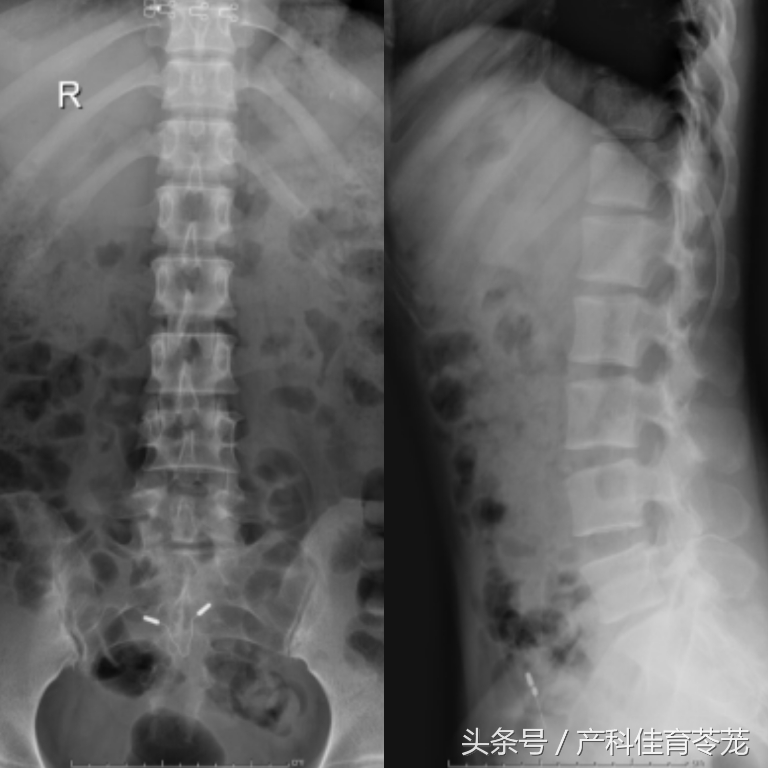 椎间盘突出如何保养防复发,椎间盘突出手术复发后中医治疗