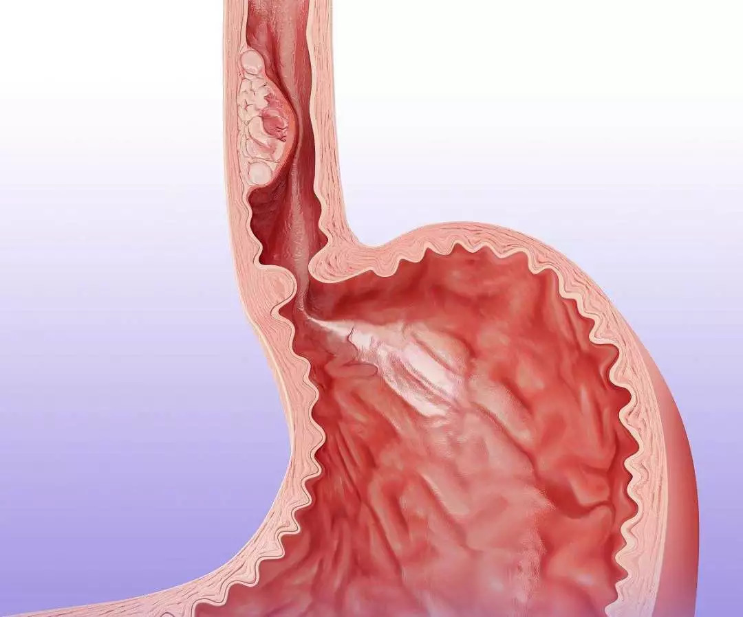 八个细节助你远离食管癌,哪些人要警惕食管癌